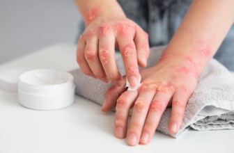 Psoriasis Explained