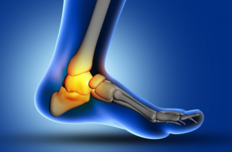Plantar Fasciitis Guide