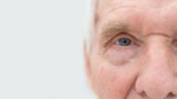 Cataract Surgery Explained