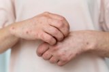 Skin Rash Symptoms