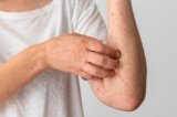 Atopic Eczema Explained